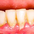 Cao răng: Tác hại và cách phòng ngừa
